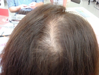 女性40代からの薄毛の原因と対策