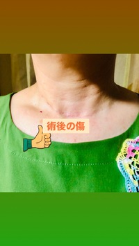 術後の傷跡順調に回復かなぁ