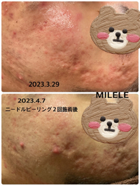 ニードルピーリング®︎でツルピカ♪本気で肌再生を目指す方に