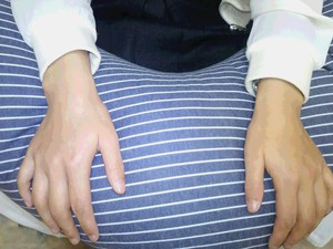 左右手首痛／右と左では原因は違います。