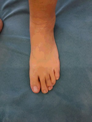 パンプスで花粉症悪化／足が歪んで顔も歪む。